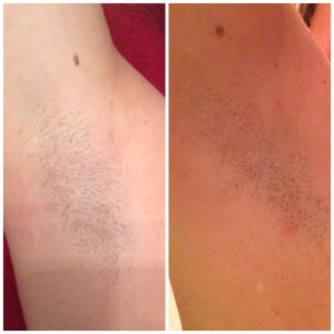 The Cheshire Aeshetic Clinic Chester | IPL Laser Hair Removal | Armpit before and after