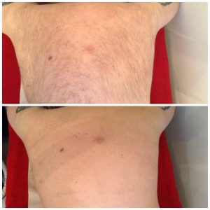 The Cheshire Aeshetic Clinic Chester | IPL Laser Hair Removal | Back before and after