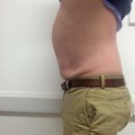 The Cheshire Aeshetic Clinic Chester | Laser Lipo Inch Loss and Fat Reduction | Man's stomach after