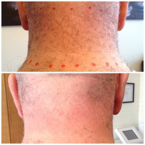 The Cheshire Aeshetic Clinic Chester | IPL Laser Hair Removal | Neck before and after