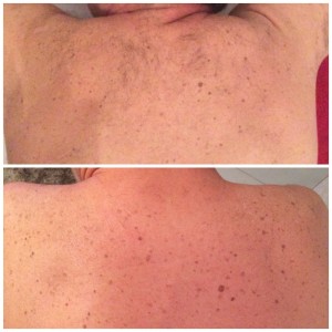 The Cheshire Aeshetic Clinic Chester | IPL Laser Hair Removal | Shoulders before and after