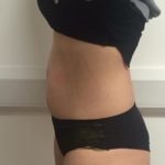 The Cheshire Aeshetic Clinic Chester | Laser Lipo Inch Loss and Fat Reduction | Stomach after