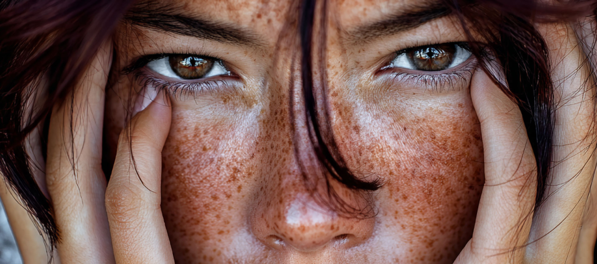 The Cheshire Aeshetic Clinic Chester | IPL Skin Pigmentation Treatment Laser Hair Removal | Freckles